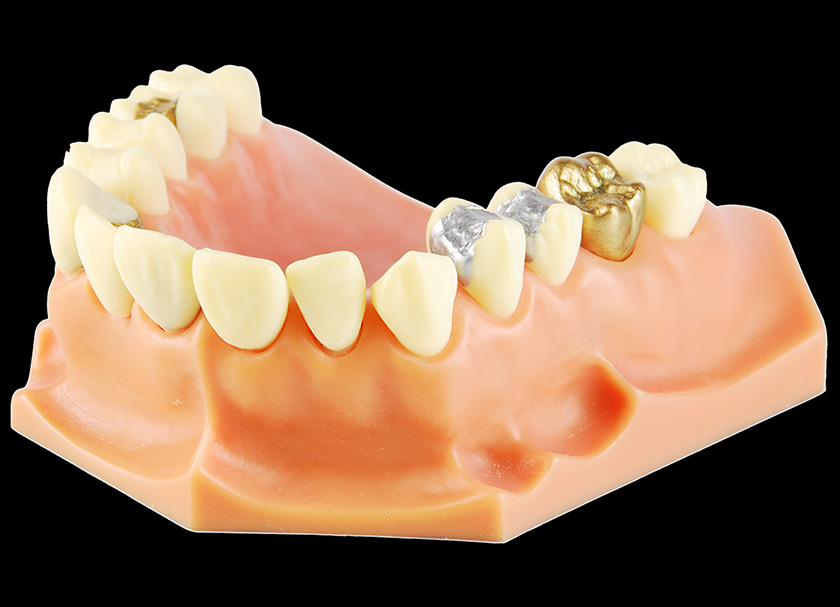 cost of dental bridge in delhi