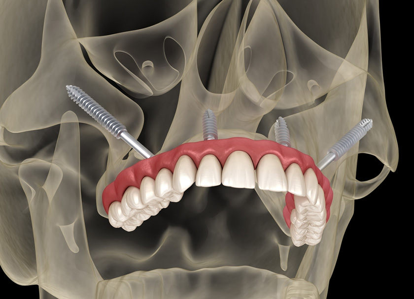 Basal Implants