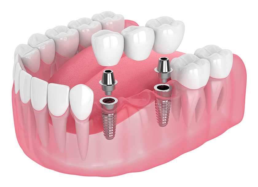 Dental Implants