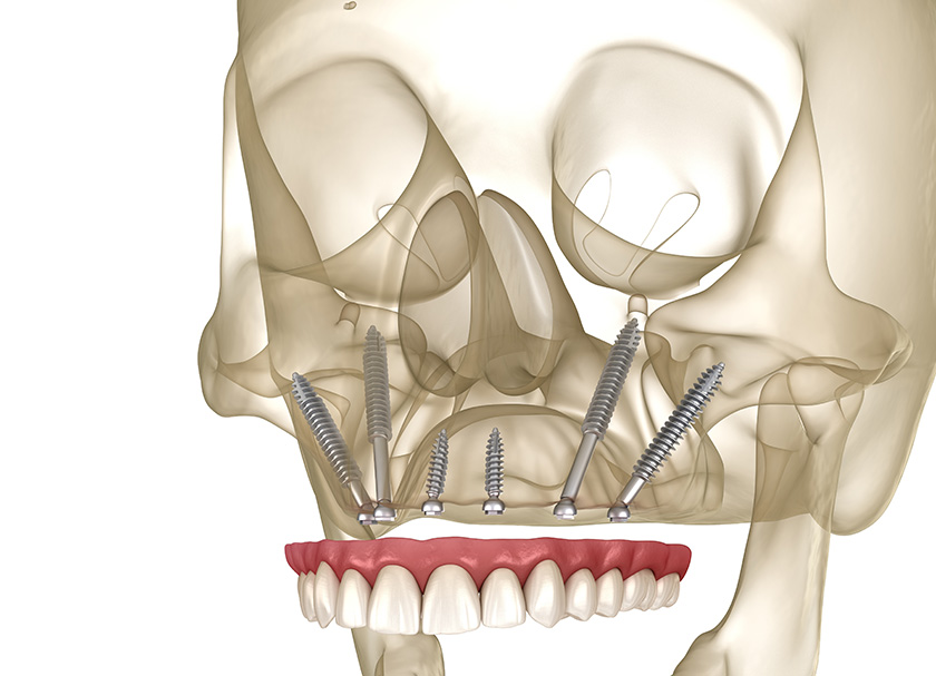 Zygomatic Implants