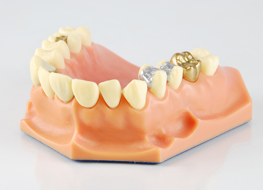dental filling cost in delhi