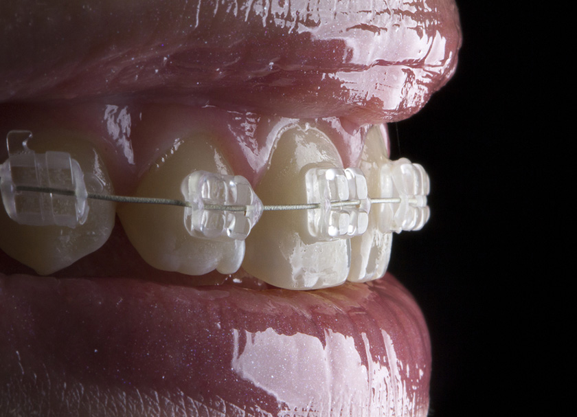 Ceramic Braces