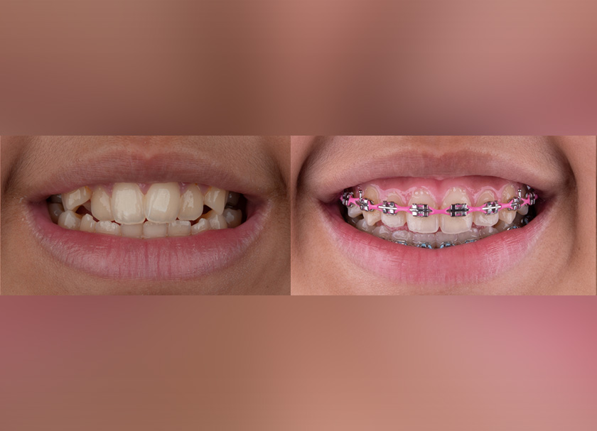 Metal Braces