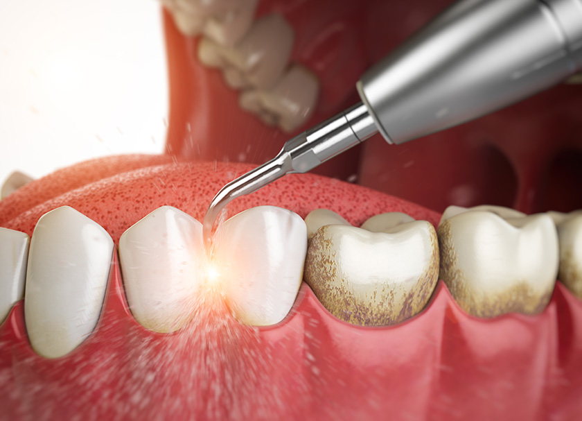 Teeth Cleaning in Delhi​