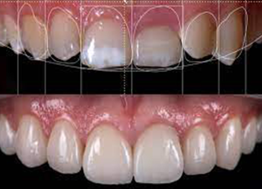 Bespoke Digital Smile Design